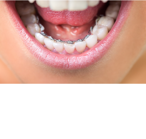 裏側矯正について