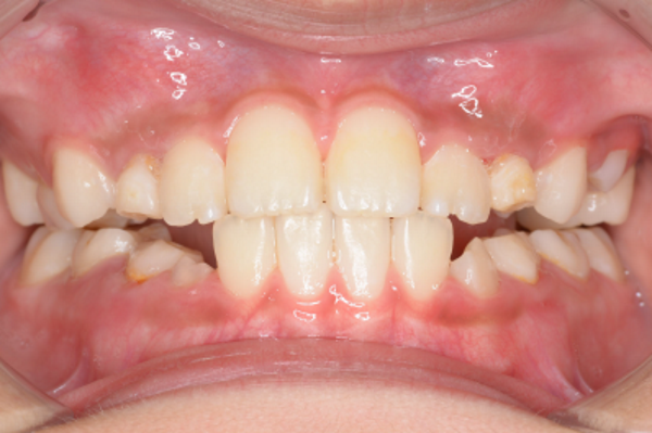 After image