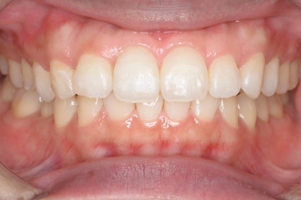 After image